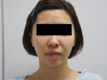 【今回もダウンタイム僅少】31歳女性頬・アゴ下ベイザー脂肪吸引　1年まで