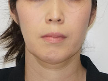アゴのクレヴィエル2本　梅干しと二重アゴを改善し若々しい顔立ちへ