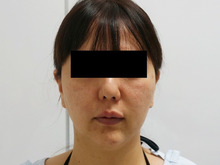 40歳女性　スプリングスレッド術後シグネチャーリフト+頬アゴ下ベイザー+脂肪注入