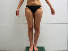 30歳女性　他院臀部脂肪吸引後（顔面脂肪注入）ベイザー大腿臀部膝周り脂肪吸引　3か月まで