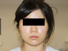 149㎝51㎏　　頬アゴ下ベイザー脂肪吸引
