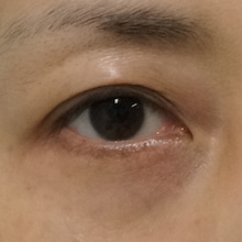 目の下のダーマペン+FGF　２回治療お写真ご紹介