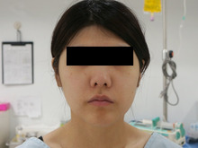 24歳女性　157㎝55㎏　頬・アゴ下ベイザー　遠方からいらしてくださいました