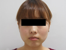 24歳女性　156㎝48㎏　頬アゴ下ベイザー+オトガイ脂肪注入　3か月まで
