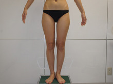 28歳　大腿臀部膝周りベイザー+CRFバスト　見違える若々しさ　術後8か月　吸引箇所