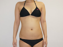 27歳女性169㎝53㎏　腹部腰部ベイザー　幼児体型からクビレグラビア級に大変身？