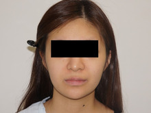24歳女性　　幼顔から大人女性に　ベイザー頬アゴ下脂肪吸引　2