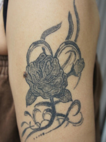 黒一色のTattooはQ-スイッチYAGレーザーで効果的