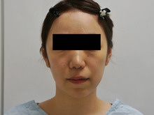 34歳女性頬アゴ下ベイザー脂肪吸引　　中顔面・ほうれい線・オトガイ脂肪注入
