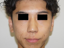 26歳男性鼻プロテーゼ（6mm）と鼻尖修正