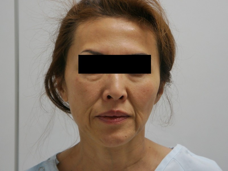 51歳女性シグネチャーフェイスリフト+頬ベイザー+中顔面・ほうれい線・オトガイ脂肪注入