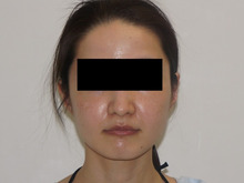 34歳女性　　頬・アゴ下ベイザー+中顔面・ほうれい線脂注（大腿採取）