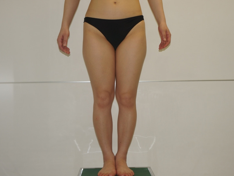 39歳女性　太ももお尻膝周りのベイザー脂肪吸引
