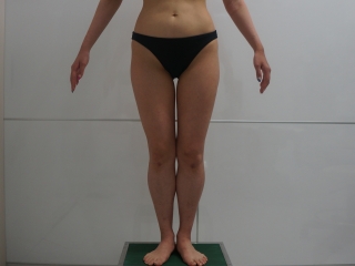 35歳女性　大腿臀部膝周りVASER+CRFバスト　大腿の写真ご紹介
