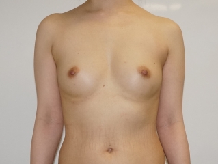 38歳女性151cm43kg大腿臀部膝周りベイザー脂肪吸引+CRFバスト　7ヶ月まで