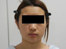 24歳女性　頬アゴ下ベイザー脂肪吸引　