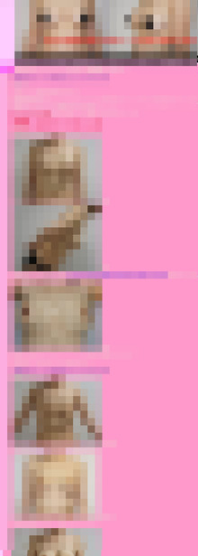 52歳女性バッグインプラント除去→CRF豊胸　半年まで