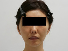 あ・・・あがってるΣ(･ω･ﾉ)ﾉ！　　　　39歳女性ミントリフト　　10ヶ月まで