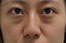 20歳　目の下のクマ退治　経結膜脱脂術+眼窩脂肪注入