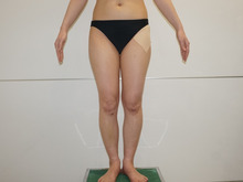 38歳女性151cm43kg大腿臀部膝周りベイザー脂肪吸引+CRFバスト　7ヶ月