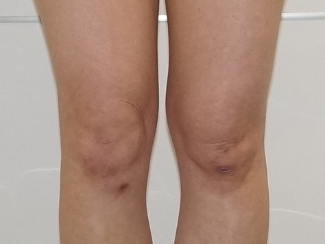38歳女性151cm43kg大腿臀部膝周りベイザー脂肪吸引+CRFバスト　7ヶ月　膝に注目！