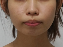 あごクレヴィエル2.2ccで一気に大人の雰囲気ただよう美人顔＼(,,・,,ω,,・,,)／