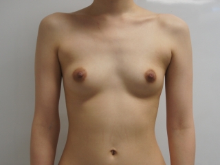 24歳女性大腿臀部膝周りVASER+CRF豊胸　157cm47kg　バスト半年まで