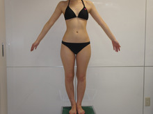 24歳女性　157cm47kg　大腿臀部膝周りVASER+CRF豊胸　半年目まで下半身報告