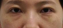 32歳女性　経結膜脱脂術+眼窩脂肪注入で目の下若返り(*^▽^*)