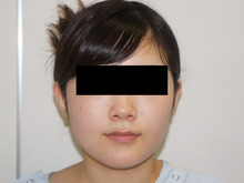 22歳女性　154cm49kg　頬・アゴ下ベイザーで大人っぽい美人がお