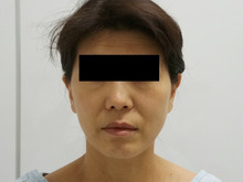 43歳女性ミントリフト　10ヶ月まで