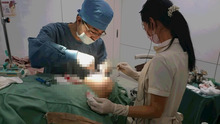 耳介軟骨移植を伴う、鼻尖形成術（縮小と鼻尖部の高さを出す）+I型プロテーゼ