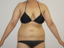20歳女性163cm74kg　　　腹部（肋骨縁・腸骨上）Vaser 脂肪吸引