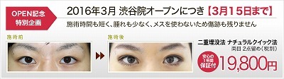 【期間限定】シンシアの埋没法（ナチュラルクイック）が19800円！！