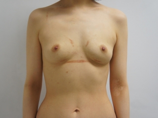 35歳女性　大腿臀部膝周りVASER+CRFバスト　なぜこんなに生着したのか・・・