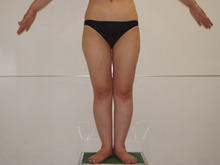 【他院術後】　35歳165cm59kg　大腿臀部膝周りベイザー脂肪吸引
