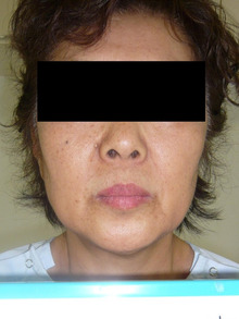 【超長期経過写真】フェイスリフト8年後　手術当時59歳