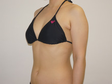 37歳女性　156cm53kg　二の腕ほっそりベイザー脂肪吸引