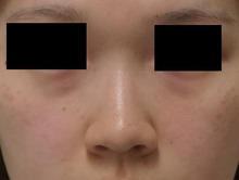 【1ヶ月後】鼻根部に殆ど高さの無い患者様。クレヴィエルですっきりと立体感！！