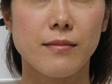 左右差が強い患者様のエラボツリヌス注射