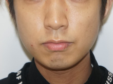 男性のクレヴィエル2ccでさらなるオトコマエ化