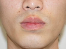 ★3　26歳男性　唇縮小ですっきりとした男前の雰囲気に