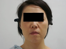 フェイスリフト？ミントリフト？　いえ、VASER頬アゴ脂肪吸引+脂肪注入です（●｀・ω・´●）