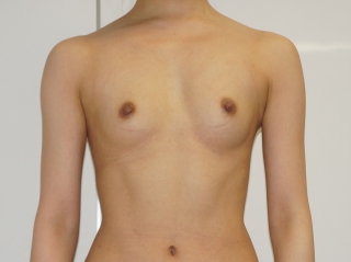 【美乳に大変化】22歳女性　大腿臀部膝周りVASER+CRFバスト②　　3ヶ月バスト