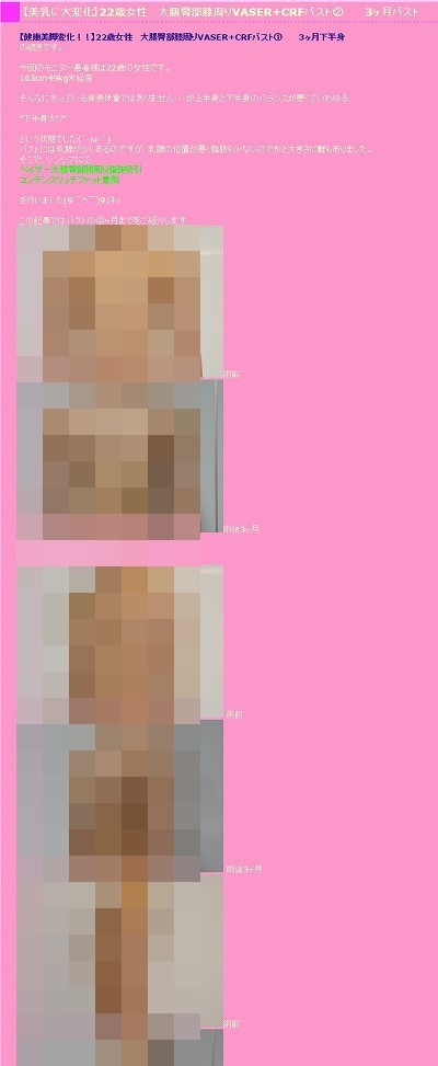 22歳女性　大腿臀部膝周りVASER+CRFバスト②　3ヶ月バスト