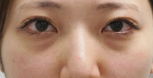 27歳女性　若いのに目の下に“クマ”　　切らない手術で改善(*^^*)