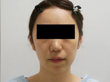 34歳女性頬アゴ下ベイザー脂肪吸引　中顔面・ほうれい線・オトガイ脂肪注入→ミントリフト