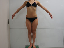 32歳女性　大腿臀部膝周りVASER+CRFバスト　下半身太り卒業　　1　（大腿臀部）