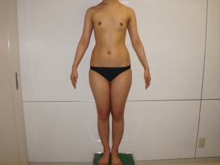 ☆46　　24歳女性AAカップで殆ど胸がない状態からの腹部腰部ベイザー+CRF豊胸
