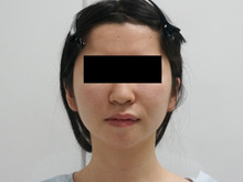 26歳女性　これがシンシアの頬アゴ下ベイザー脂肪吸引　о(ж＞▽＜)ｙ ☆